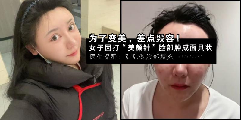 【女人】为了变美,差点毁容!女子因打“美颜针”脸部肿成面具状,医生警告:别乱做脸部填充