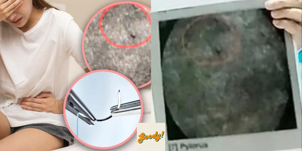 Thai Woman Endures 18 Years Of Pain After Childbirth, Discovers Needle ...